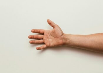 carpal tunnel syndrome